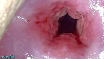 Uncensored Japanese Cervix Stretching and Uterus Dilation with Penetration